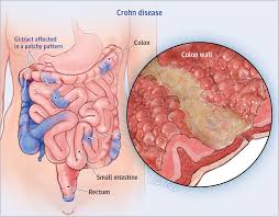 corhon's disease