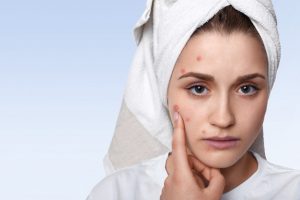 CBD oil to relieve acne 1