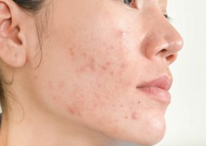 CBD oil to relieve acne